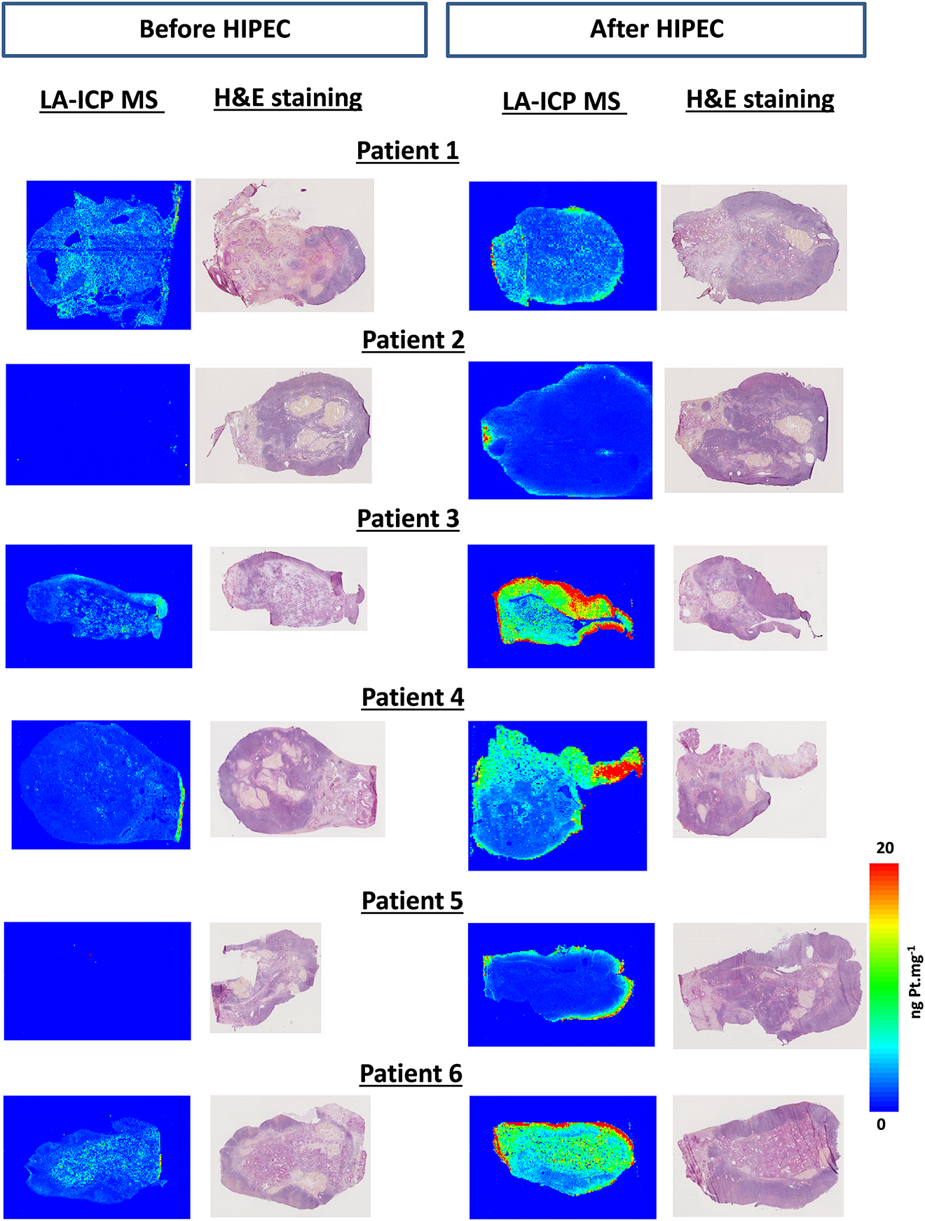 Figure 2: LA-ICP MS quantitative images of cryosections of the ovaries of the six patients.For each patient, the LA-ICP MS localization of elemental platinum (195Pt) is illustrated before (left panel) and after (right panel) HIPEC. For each tissue, the hematoxylin/eosin staining of the immediate adjacent slice is presented at the right of the LA-ICP MS picture. Note that no platinum was detected before HIPEC in the ovaries of patients P2 and P5. Color scale on the right from 0 to 20 ng mg−1 Pt applies to all pictures. Note that for patient P2 after HIPEC treatment, the signal (of ca. 500 ng mg−1) in the core of the ovarian elemental image is due to an analytical artifact.