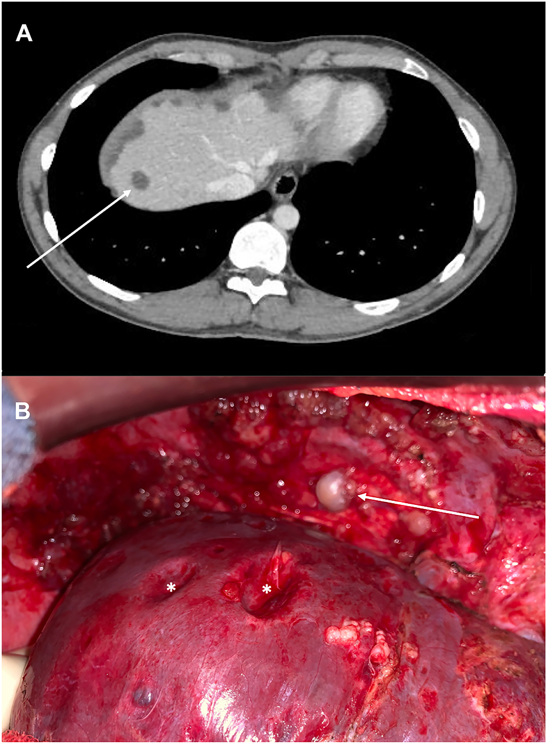 Figure 1:
CT-scan (A) revealed hypodense liver lesions (arrow) at the diagnosis of left colon adenocarcinoma with synchronous peritoneal metastases. Explorative laparotomy (B) highlighted diaphragmatic peritoneal metastases (arrow) exerting pressure on the liver surface, called «scalloping» (star).