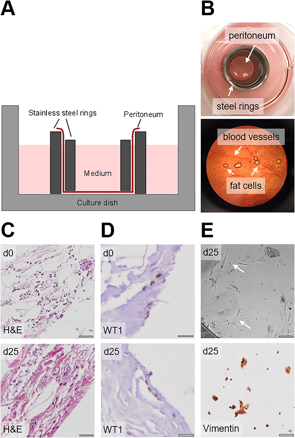 Figure 1: 
Establishment of a human ex vivo peritoneal model.
(A) Schematic setup of the ex vivo peritoneal model. (B) Photographic images of the peritoneal model. (C) H&E staining of peritoneal tissue on day 0 and day 25 of culture; scale bars 200 µm. (D) WT1 staining of peritoneal mesothelial cells on day 0 and day 25; scale bars 20 µm. (E) Light microscopy and vimentin staining of outgrowing fibroblasts on day 25; scale bars 200 μm.
