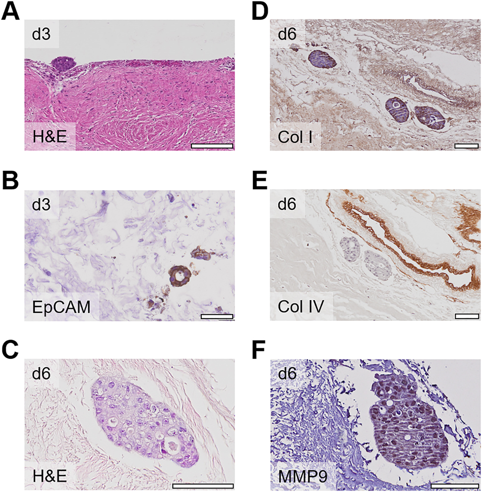 Figure 4: 
Modeling peritoneal metastasis using patient-derived organoids.
(A) Patient-derived organoids of different donors attached to the peritoneal surface at day 3 after coculture; scale bar 200 µm. (B) Coculture of patient-derived organoids with cellularized peritoneal tissue after 3 days; sections were stained with EpCAM to distinguish between EpCAM positive tumor cells and negative peritoneal cells; scale bar 40 µm. (C–E) Coculture of patient-derived organoids with decellularized peritoneal tissue; after 6 days, sections were stained with H&E (C) and for collagen I (D), collagen IV (E), and MMP9 (F); scale bars 100 μm.
