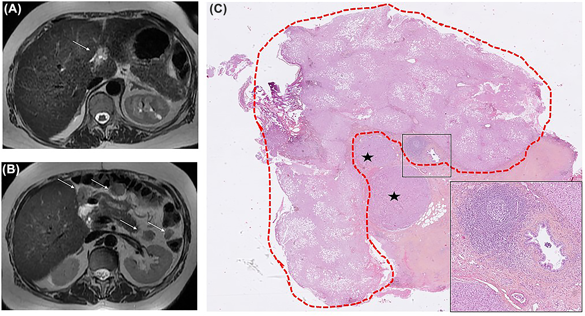 Figure 1:
Magnetic resonance imaging (MRI) of the liver and peritoneum (axial T2 weighted images).
(A) Initial MRI: ill-defined T2 hyperintense nodule within the falciform ligament of the liver (arrow). (B) MRI at 3 months: Appearance of several peritoneal metastases (arrows). Note the absence of any parenchymal liver tumour in both images. (C) Histopathological analysis: hepatocellular carcinoma (asterisks) in the falciform ligament of the liver, representing the starting point of the peritoneal disease. Ectopic liver is circled in red (greater axis: 15 mm), with detectable steatosis (HES, ×6). Note the independent vasculo-biliary stalk, highlighted in the inset (HES, ×50). HES: hematoxylin-eosin-saffron.