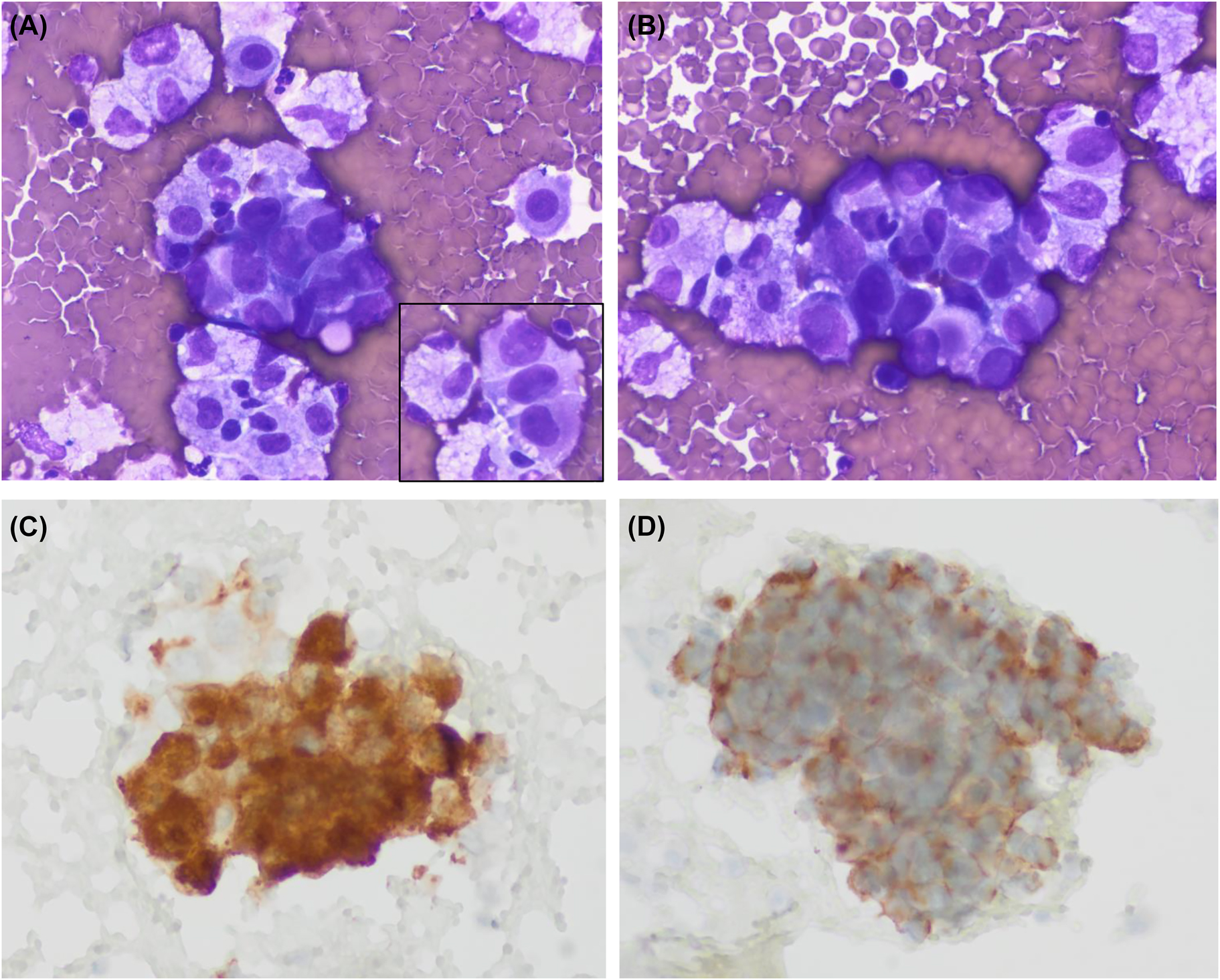 Figure 1:
Cytologic images of the pleural effusion sample. (A, B) Medium size clusters of large neoplastic cells showing epithelioid morphology. Nuclei are large and pleomorphic with no spindle cells. The inset of panel A shows a short cord of tumoral cells separated by cell windows (Diff-Quik, ×600 respectively). (C, D) Tumoral cells showing immunoexpression of c-kit and DOG1, respectively (immunoperoxidase).