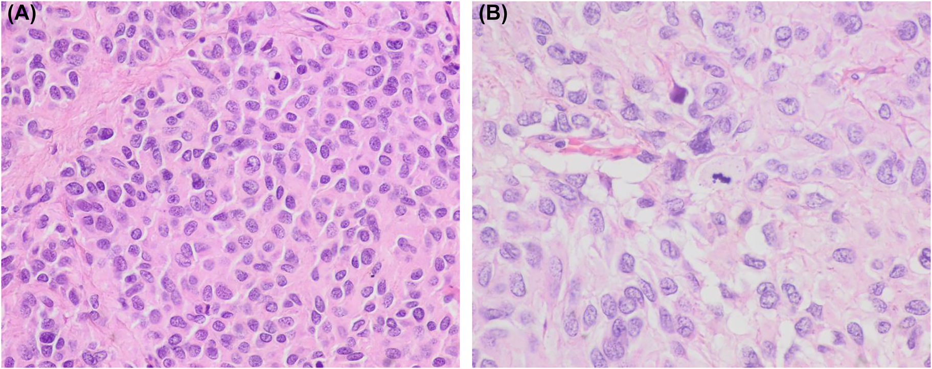 Figure 2:
Histologic images of the abdominal tumor. (A, B) Histology of the ileum tumor showing predominant epithelioid cell morphology. A mitotic figure is evident in image B (hematoxylin and eosin, ×400 and ×600, respectively).