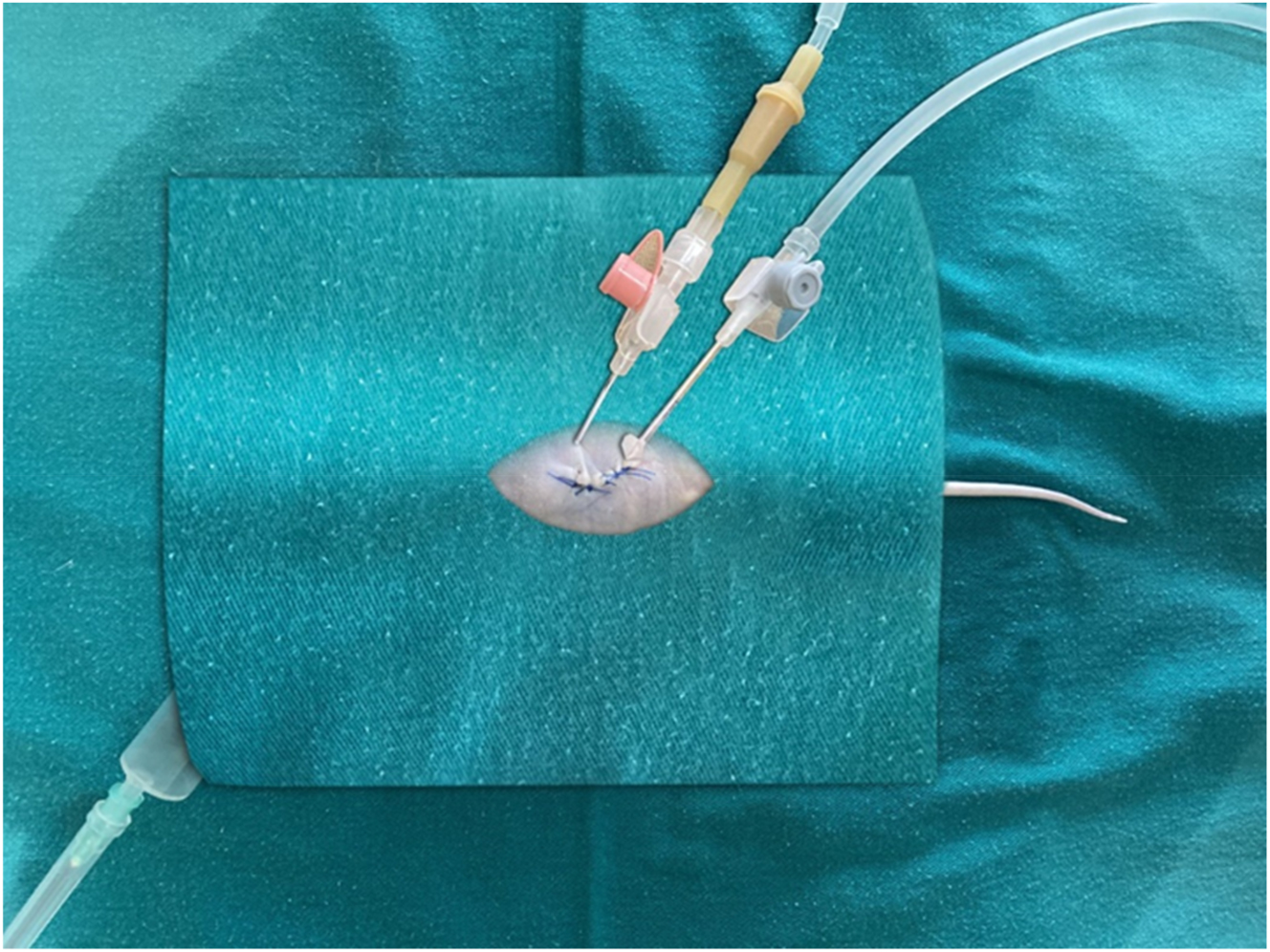 Figure 1: 
Preparation of the model before the application of intraperitoneal chemotherapy, placement of the catheters.
