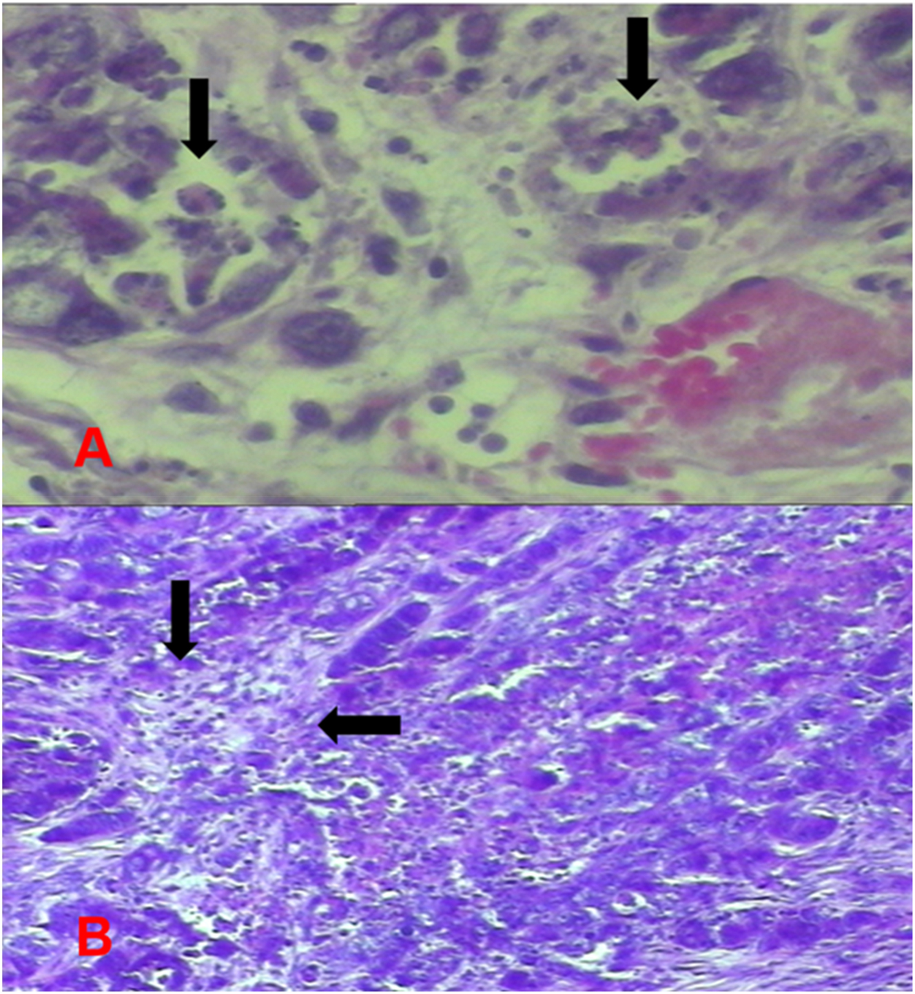 Figure 6: 
Group 3 (hyperthermic MMC) tumor images. (A) Increased apoptosis in tumor cells. (B) Areas of tumor necrosis.
