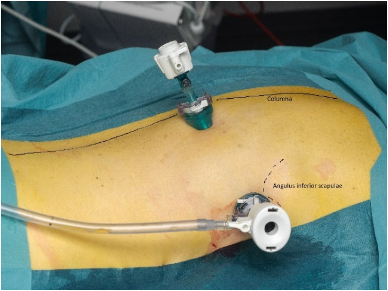 Figure 1: 
Pressurized IntraThoracic Aerosol Chemotherapy in prone position.
