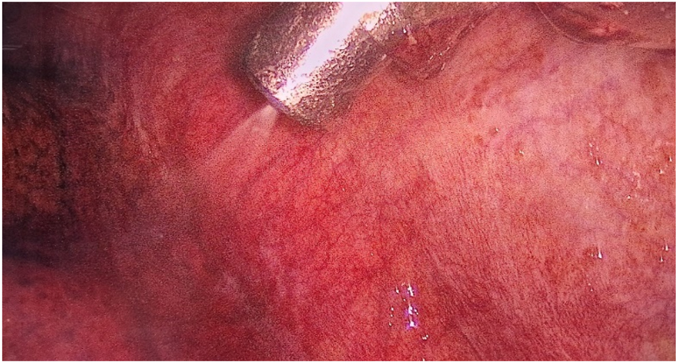 Figure 2: 
View of the left pleural cavity during nebulization of chemotherapy.
