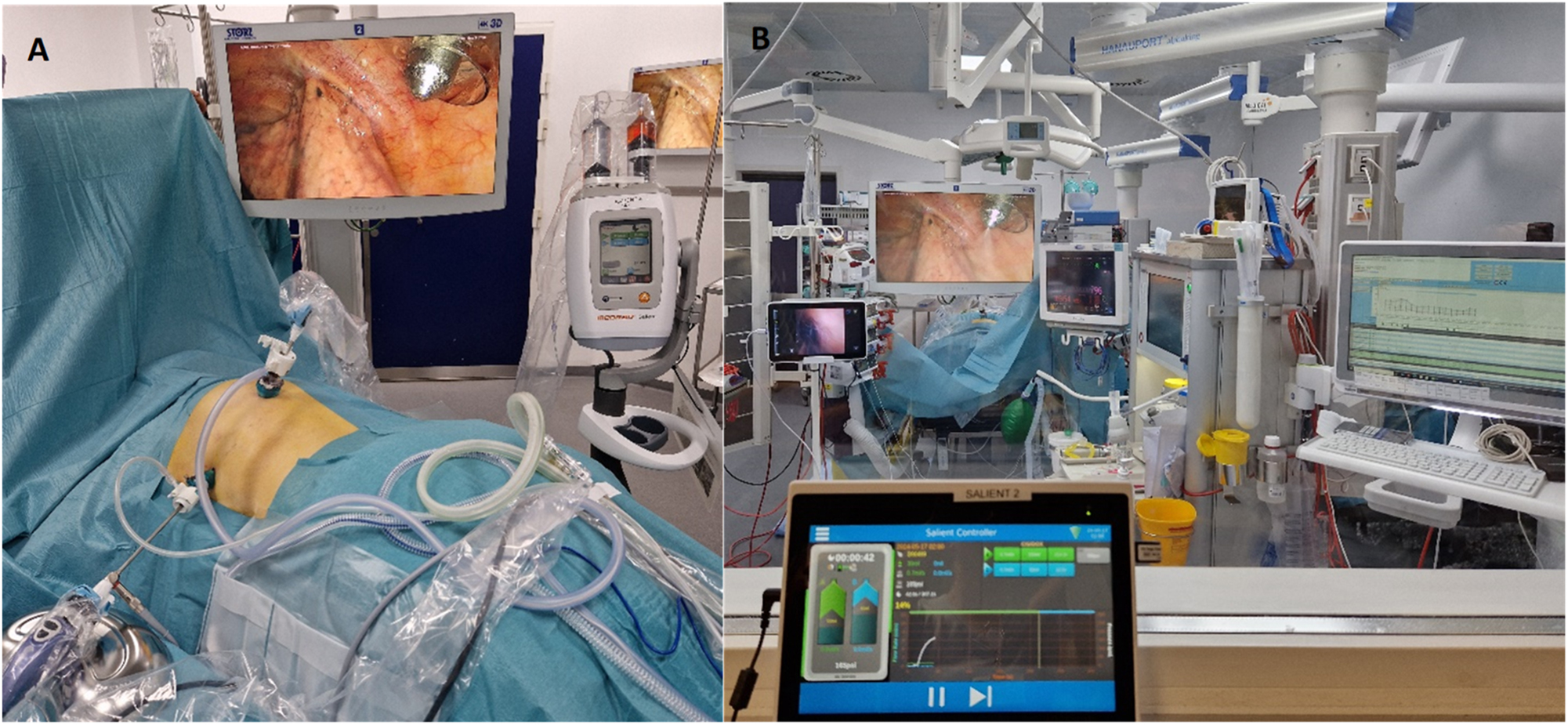 Figure 3: 
The arrangement during Pressurized IntraThoracic Aerosol Chemotherapy (PITAC) from inside and outside the operating room. (A) The arrangement from inside the operating room with the patient in prone position. Two trocars: 12 mm balloon trocar just next to the spine and a 5 mm trocar below the left scapulae. The left pleural cavity visible with the CE-certified nebulizer in the 12 mm balloon trocar. Microinjector loaded with cisplatin and doxorubicin connected to the CE-certified nebulizer covered by plastic bag. (B) The arrangement from outside the operating room. The following monitors are visual from the left: video-assisted double-lumen endotracheal tube with a view of the tracheal bifurcation, left pleural cavity with the active CE-certified nebulizer, and three monitors related to the anesthesiology. In the front, the remote-control tablet for the microinjector with increasing pressure during nebulization.
