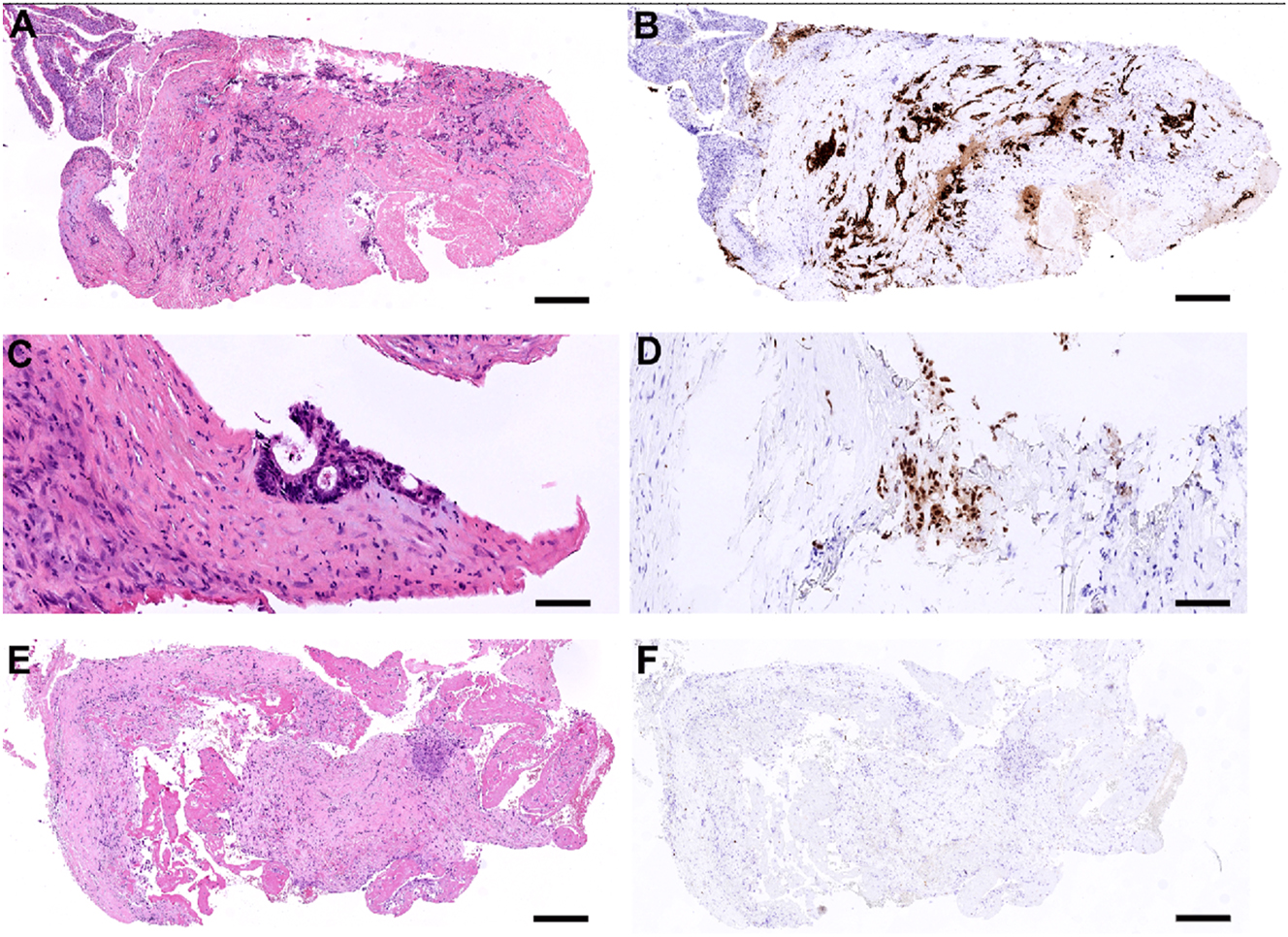 Figure 5: 
Histological features of pleural metastasis from rectal cancer before and after PITAC (patient 1). (A and B) Biopsy from the upper left-sided pleura at baseline, showing metastatic rectal adenocarcinoma, TRGS 4 (a, H&E. B, CDX2-immunostaining). Scale bar: 500 μm. (C and D) Higher magnification of biopsy from the lower left-sided pleura at baseline, showing a small focus of metastatic rectal adenocarcinoma, TRGS 2 (C, H&E. D, CDX2-immunostaining). Scale bar: 100 μm. (E and F) Biopsy from the left pleura taken prior to PITAC2, showing complete response (TRGS 1). Regressive fibrosis with mesothelial proliferation and fibrin is shown. No metastatic tumor cells are found at this location (E, H&E. F, CDX2-immunostaining). Scale bar: 350 μm.
