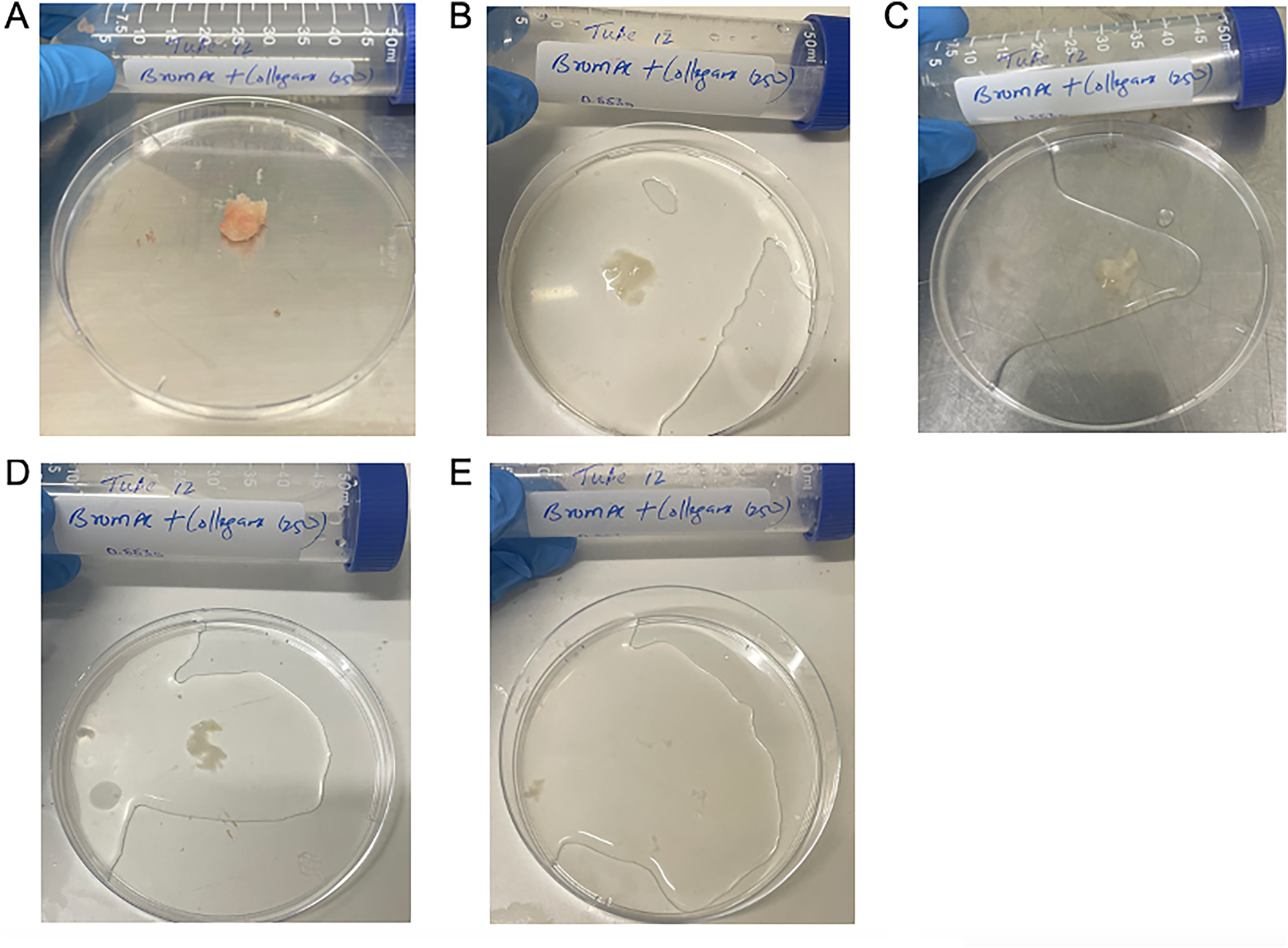 Figure 3:
Qualitative demonstration of dissolution of hard mucin when submersed in BromAc
®
+ collagenase 250 ug/mL, trial 2. A: 0 h, B: 1 h, C: 3 h, D: 5 h, E: 24 h.