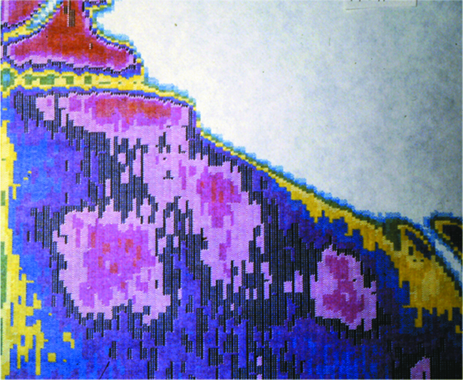 Figure 2: A thermographic image after application of four patches to the back of a patient. The quantitative colour image chart is not shown here. (For details see reference [11]).