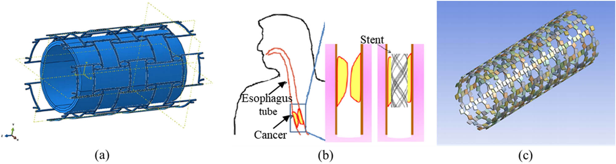 Figure 17 
                  (a) The stent–plaque–artery vessel system’s geometrical relationship [251], (b) an auxetic stent to support and open an esophagus [168], and (c) stent based on a rotating square pattern with two levels of hierarchy [54].
               