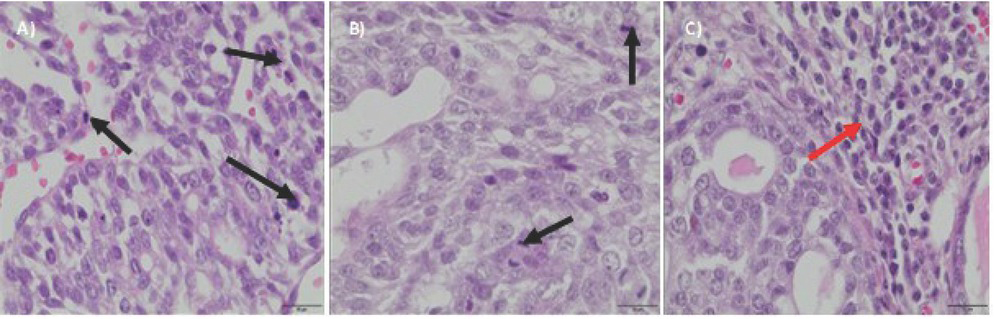 Figure 3 Biopsy images of tumour samples with 40x magnification; hematoxylin and eosin staining was applied. DMBA-induced tumour in the control group – II grade adenocarcinoma (a), in the group with the zinc microparticles supplementation – II grade adenocarcinoma (b), in the group supplemented with zinc nanoparticles – I grade adenocarcinoma (c). Black arrows indicate areas of the increased proliferation. Red arrow indicate inflammatory infiltrates.