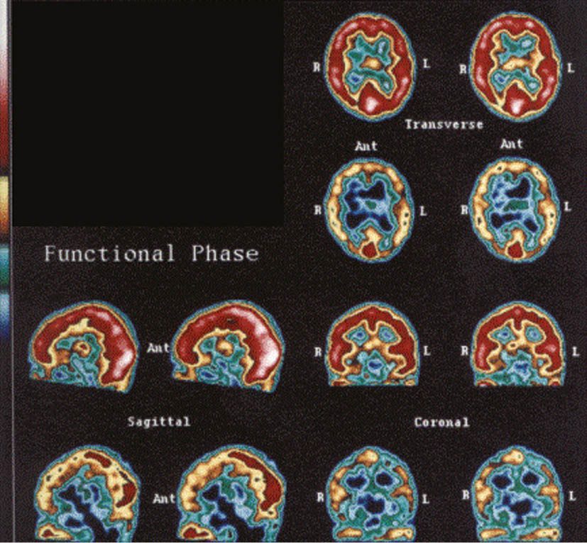 Figure 1: Normal SPECT brain scan – smooth, uniform, distinct outlines, no rough edges or holes in cerebral hemispheres or abnormal temporal lobes. Abnormal SPECT brain scan – rough edges, holes in cerebrum, temporal lobes obliterated or poorly outlined.