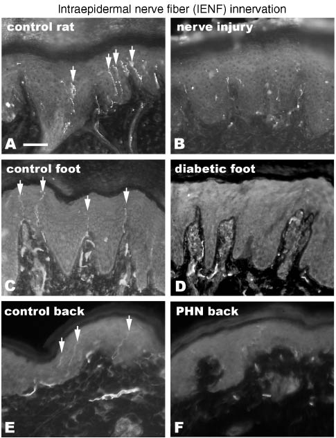 Figure 2: Intraepidermal nerve fiber (IENF) innervation loss is detected among numerous disorders characterized by chronic pain, including overt nerve trauma, metabolic disorders, and viral infections.IENF are depicted by white arrows in A, C, E to demonstrate the loss of IENF following spinal nerve ligation injury in rats (compare A and B), human painful diabetic neuropathy (DN, compare C and D), and human post-herpetic neuralgia (PHN, compare E and F). See Ref. (88) for additional study details. Scale bar=50 μm for A–F.