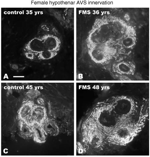 Figure 3: Arteriovenus shunt (AVS) innervation appears exuberant among FMS patients.Control hypothenar biopsies from different aged subjects (A and C) have less total innervation to AVS structures than age-matched FMS biopsies (B and D). See Ref. (23) for additional study details. Scale bar=25 μm for A–D.