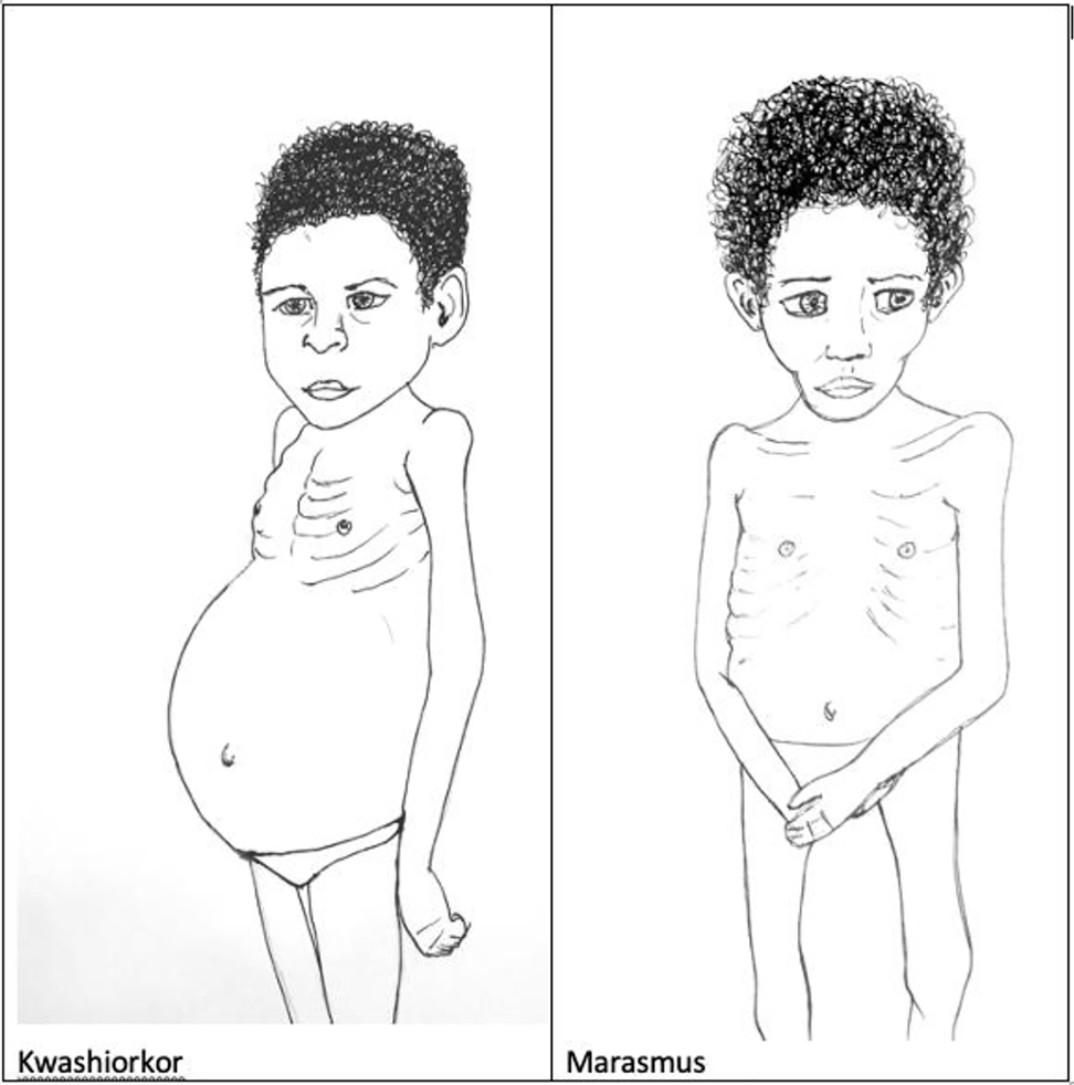 Figure 2: 
Clinical signs of kwashiorkor and marasmus.
