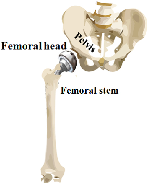 Figure 20:
Total hip replacement.
