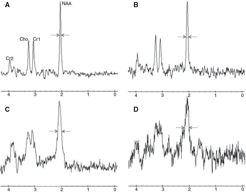 Figure 2: Single-voxel MRS spectra with varying linewidths were obtained using the PRESS sequence (TE/TR=144/2000 ms) on a 1.5 T system.The peaks for NAA, creatine (Cr1 and Cr2), and choline (Cho) are shown. A to D illustrate a range of linewidths from narrow to broad. When the linewidth is narrow, the variation in linewidth is mainly related to the transverse relaxation time (T2) of the magnetization giving rise to the signal. A longer T2 leads to a narrower linewidth. Linewidth is also directly related to the inhomogeneity of the main magnetic field within the volume of the defined voxel. Greater inhomogeneity causes a broadening of the linewidth and a reduction in the SNR. Lower SNR is reflected in the larger signal variations of the spectral baseline and peaks, as illustrated in spectrum D. The linewidths (full-width at half-maximum) are as follows: (A) 0.0485 ppm, 3.10 Hz; (B) 0.0680 ppm, 4.34 Hz; (C) 0.136 ppm, 8.68 Hz; and (D) 0.165 ppm, 10.54 Hz.