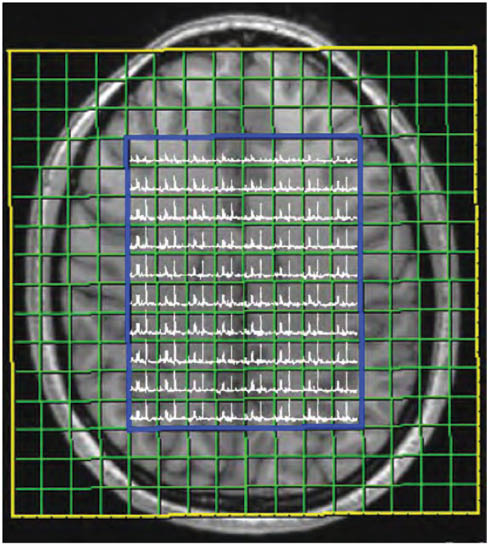 Figure 9: 16×16 phase encoding grid, 8×10 subgrid for computing spectra, and the boundary for automatic magnetic field shimming for a 2D CSI experiment.The figure also shows spectra computed by the MR system software, in picture icon form. The yellow boundary indicates the user-defined region that is partitioned into a user-defined grid of resolution voxels (here 16×16) shown in green. The blue line indicates the user-specified excitation voxel, where spectral data will be acquired for each enclosed resolution voxel. The blue line also defines the region that will be shimmed by the MR system. Note that the spatial extent of the resolution voxels is much greater than the spatial extent of the excitation voxel. This prevents artifact from spurious signal originating outside the excitation voxel through the phase encoding wraparound artifact. Spatial saturation pulses (not shown) are applied outside of the region of the solid blue line to suppress the spurious signal from outside the excitation volume.