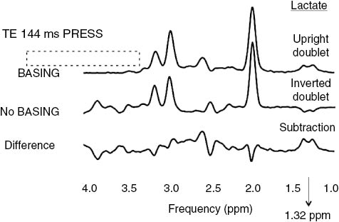 Figure 13: Brain lactate in a human volunteer studied with spectral editing on a 1.5 T system.The top spectrum was generated using PRESS with BASING pulses applied to the methine peak at 4.1 ppm. The BASING pulse caused a cancellation of the J-coupling effect and produced an upright doublet of the methyl protons at 1.32 ppm. The frequency range affected by the BASING pulse (bandwidth 180 Hz) is indicated by a dotted-line outlined rectangle. The middle spectrum was generated using PRESS without BASING pulses applied to the methine peak at 4.1 ppm. J-coupling caused the lactate doublet to be inverted at 1.32 ppm. Peaks arising from uncoupled nuclei or nuclei coupled to protons outside of the frequency range of the BASING pulse are not affected by the BASING pulse. The difference spectrum shows a cancellation of peaks unaffected by the BASING pulse. The inverted lactate doublet is subtracted from the upright doublet, leading to a larger doublet in the difference spectra. The inverted doublet has a smaller peak area than the upright doublet due to the volume misregistration effect illustrated in subsequent figures.