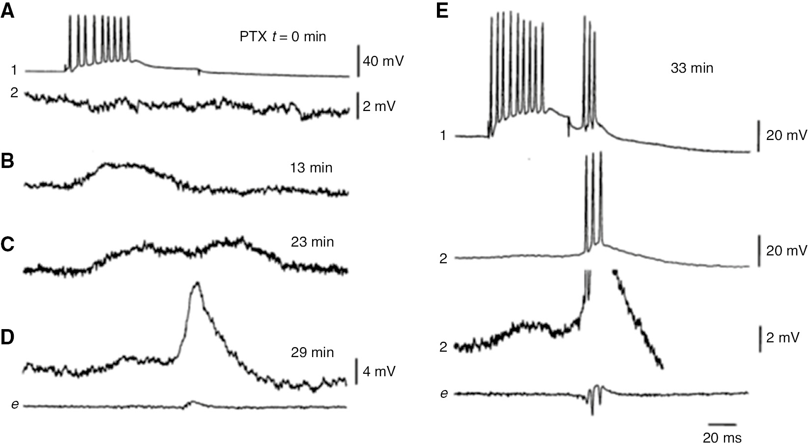 Figure 1: The behavior of a recurrent excitatory synaptic network is strongly regulated by synaptic inhibition.Dual intracellular recording from a pair of CA3 hippocampal pyramidal neurons in vitro. A burst of action potentials was repeatedly evoked in cell 1 by intracellular current injection; the effects in cell 2 (A2, B, C, D, E2) were observed as the GABAA receptor blocker picrotoxin (PTX) was gradually washed into the chamber. At first (A2), cell 2 does not ‘see’ an effect of the burst in cell 1; then a slow EPSP appears (B), then a double EPSP (C), then a double EPSP with a large second component (D), and finally a burst of action potentials in cell 2, coincident with a burst in cell 1 (E1,2) and with a field component (Ee) – that is, a population burst is evoked by cell 1 when there is sufficient disinhibition. From Miles and Wong (1987); for further analysis of this phenomenon, see Traub and Miles (1991).
