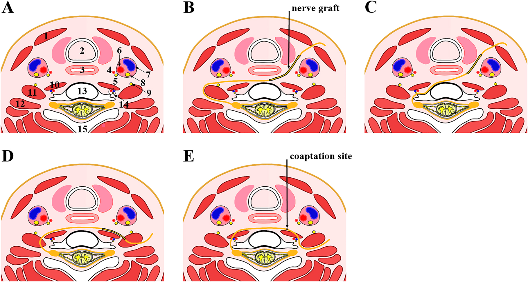 Figure 2: 
Schematic diagrams of pre-spinal routes. (A) A representative axial section through the C7 vertebral body showing normal cervical anatomical structures. (B–E) Diagrams of the original pre-spinal route by Mcguiness et al. (B), modified pre-spinal routes by Wang et al. (C) and by Xu et al. (D), and Huashan pre-spinal route (E). The anatomical structures marked by 1–15 are the same as those described in Figure 1.
