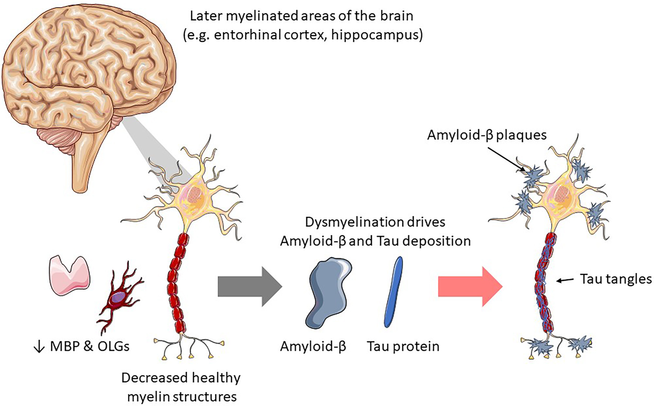 Figure 2: 
Primary degeneration in Alzheimer’s disease. An example of demyelination driven primary degeneration as found in Alzheimer’s disease (AD), including the deposition of amyloid-β plaques and Tau tangles onto demyelinated neurons.
