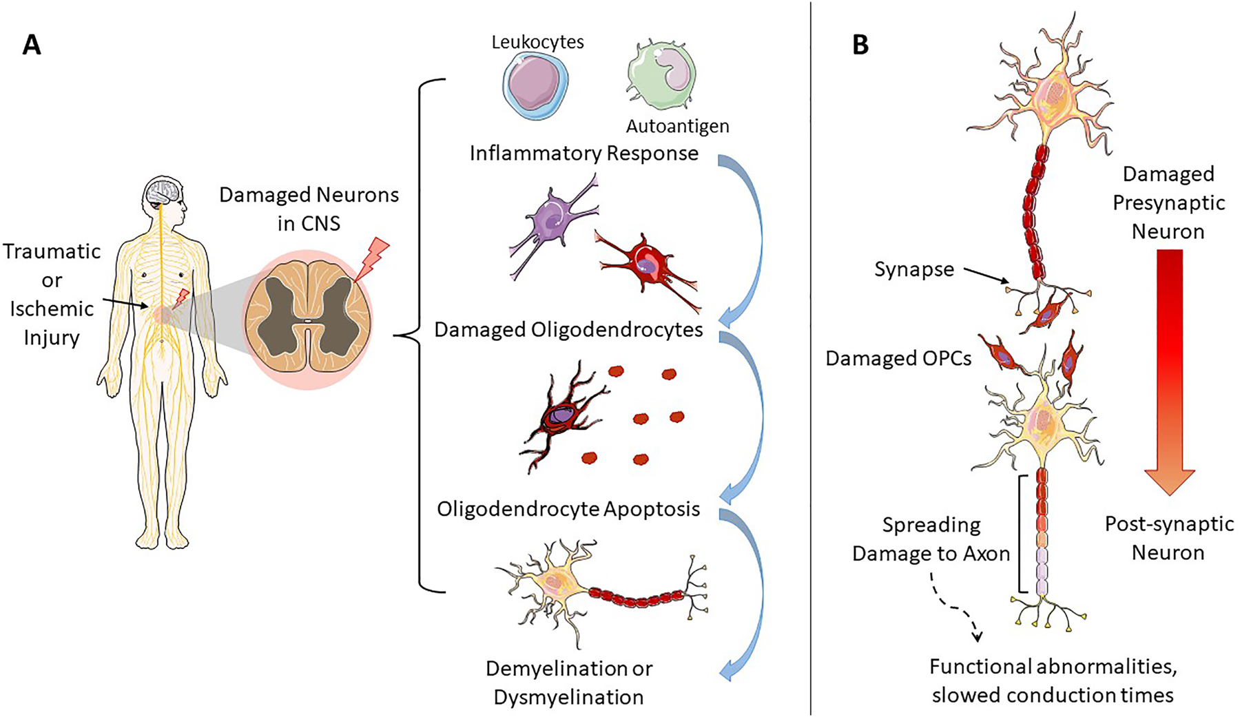 Figure 3: 
Secondary degeneration following injury. (A) An example of secondary degeneration following traumatic or ischemic injury to the spinal cord, and the resulting inflammatory products and impact on oligodendrocytes (OLG) lead to demyelination. (B) A schematic of transsynaptic degeneration, showing the spread of degeneration from the pre-synaptic to post-synaptic neurons.
