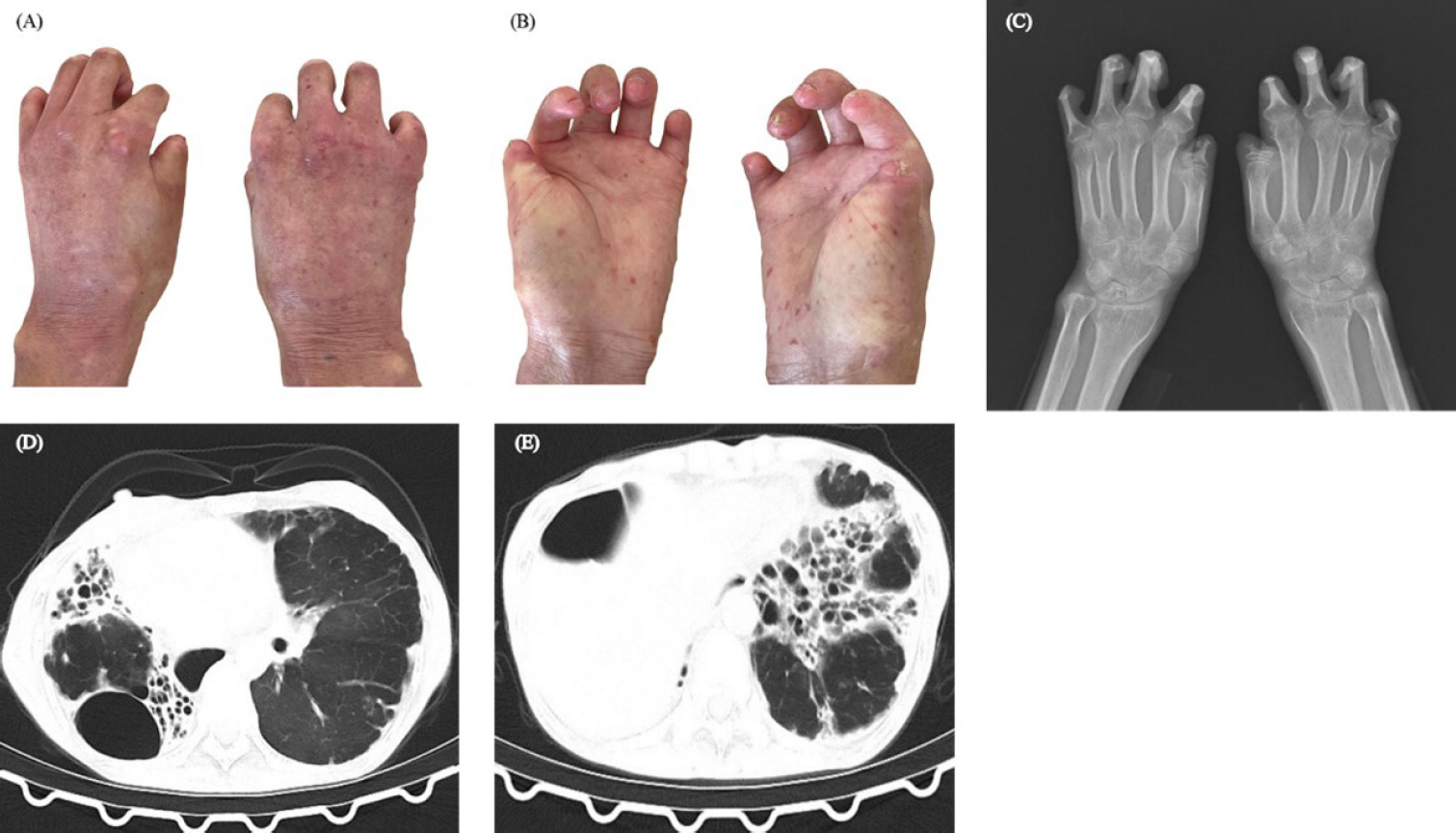Figure 1 
A, B: Flexion contractures of the interphalangeal joints. C: Hands X-ray presented acro-osteolysis. D, E: CT scan presented severe interstitial lung disease.
