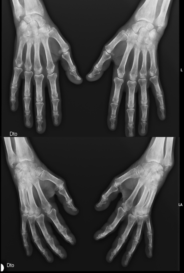 Figure 1 
Radiographs of the hands (posteroanterior, superior; oblique, inferior).
