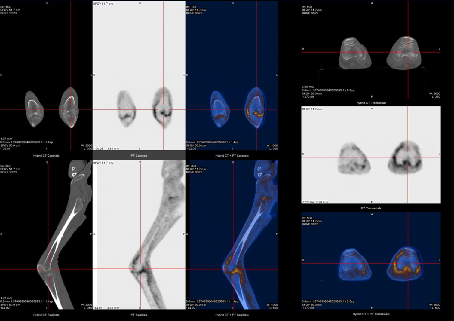 Figure 2 
18F-FDG and PET-CT study reveals slightly increased uptake of FDG in the knee joints (more in the left knee joint, with apparent extension to the subquadricipital synovial bursa region). PET-CT, pistron emission tomography-computed tomography.
