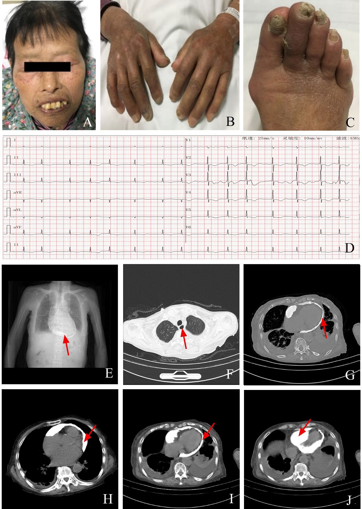 Figure 1 (A) Facial skin with telangiectasia. (B and C) The skin is thickened. (D) ECG exhibits rapid atrial fibrillation. (E) Chest X-ray shows calcification of the entire pericardium (red arrow in Figure E). (F) Chest CT notes patulous oesophagus (red arrow in Figure F).(G, H, I, and J) Chest CT reveals pericardial calcification (red arrow in Figure G, H, I, and J), ECG, electrocardiograph; CT, computed tomography.