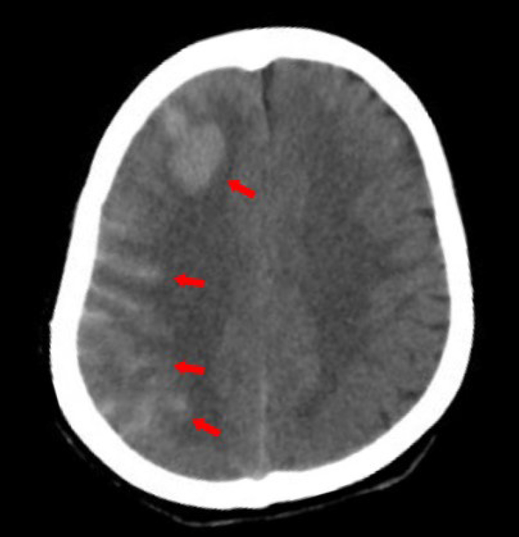 Figure 1
Computed tomography evidence of intracranial hemorrhage after surgery.