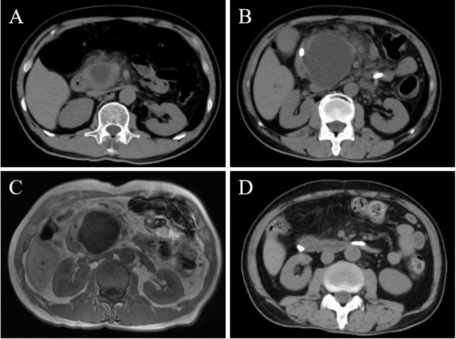 Figure 1 Images of the patient’s pancreas. Initial CT scan on admission (A) demonstrated a well-circumscribed cystic lesion (36 mm × 26 mm) within the pancreatic head, accompanied by peripancreatic exudation. CT scan after two weeks (B) showed progressive enlargement of the cyst to 67 mm × 49 mm, accompanied by dilation of the branch pancreatic ducts. Contrast-enhanced MRI (C) revealed hypointense on T1-weighted images and hyperintense on T2-weighted images within the pancreatic head, with no abnormal enhancement post-contrast administration. Follow-up CT scan after two weeks (D) demonstrated a significant reduction in cyst lesion size and resolution of peripancreatic exudation.