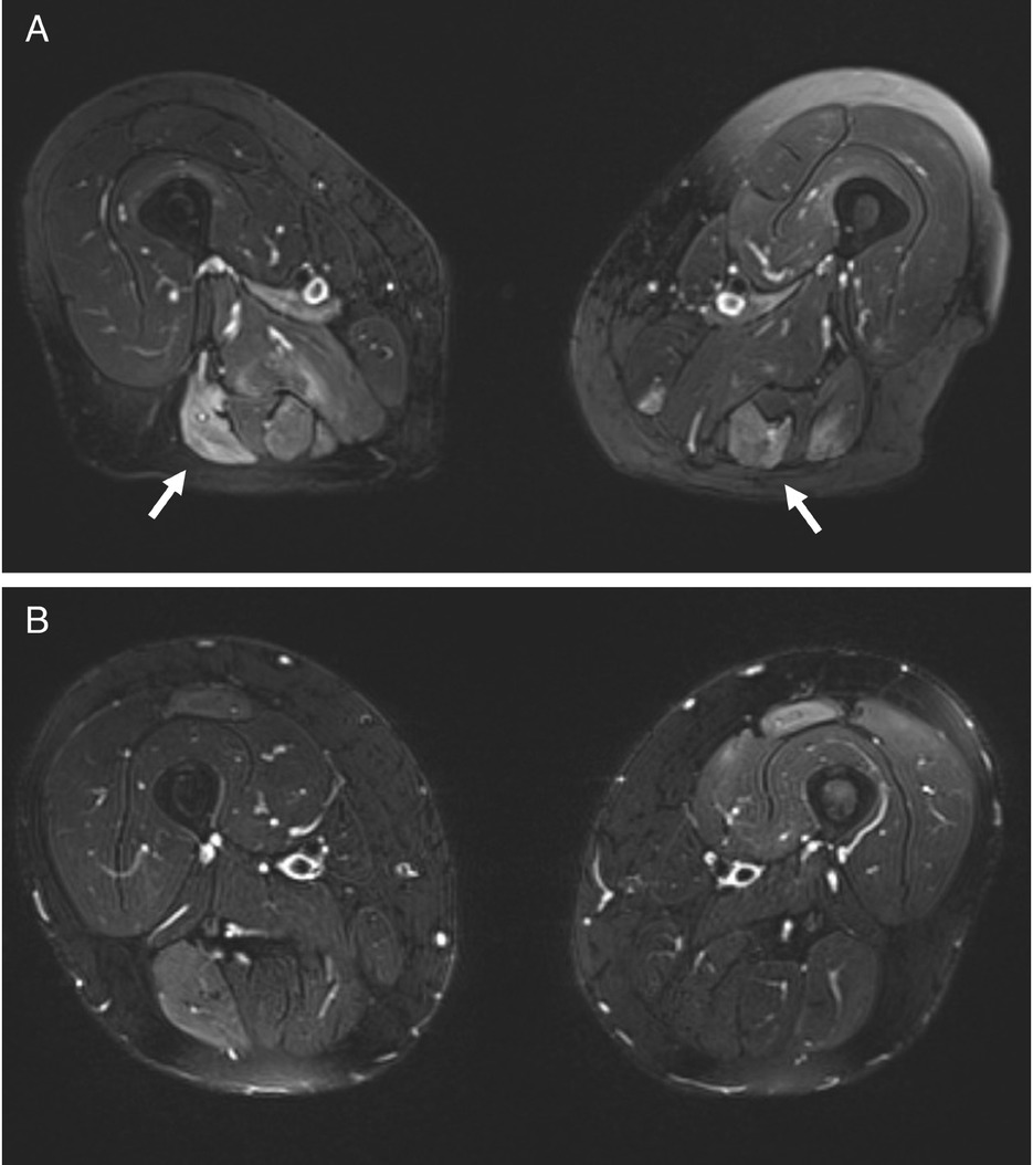 Figure 1 MRI scans of the thighs before and after rituximab therapy in Case 1. (A) Axial T2-weighted images of the upper thigh (December 2020) showing extensive areas of hyperintensity with muscle edema (white arrows). (B) Follow-up axial T2-weighted images (May 2022) of the same region demonstrate marked resolution of the previously observed edema.