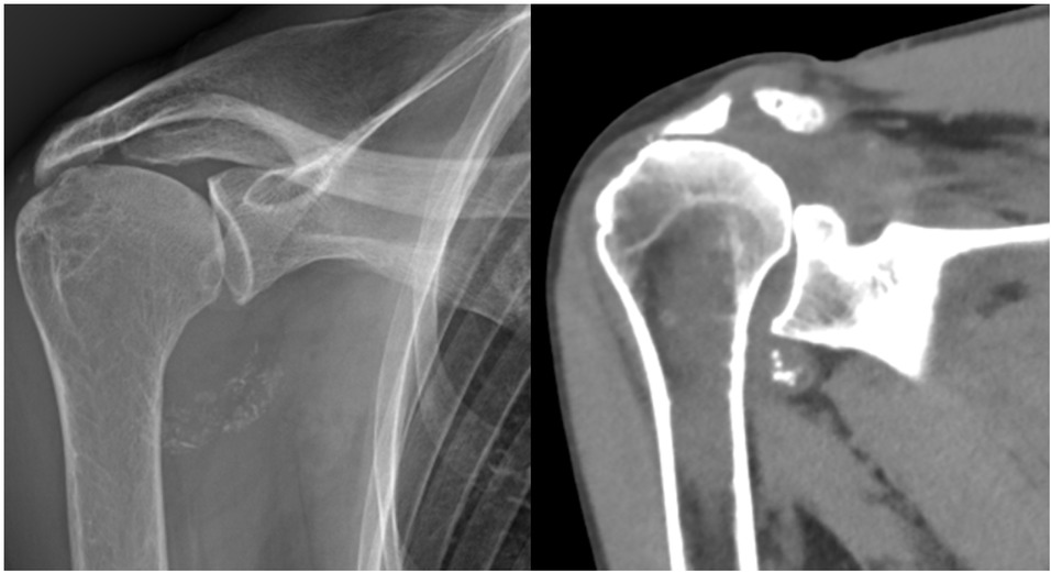 Figure 1 X-ray (left) and computed tomography (CT) scan (right) of the right shoulder showing well-defined calcifications in the axillary recess.
