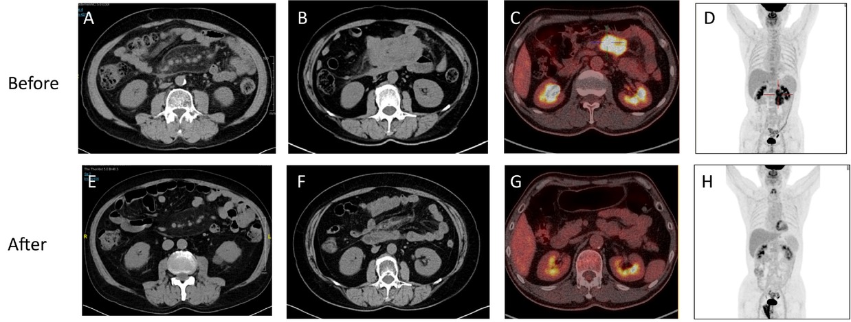 Figure 2 Characteristic imaging findings of IgG4-SM before and after treatment. (A) Abdominal CT axial image of a patient with mild IgG4-SM showing hazy shadows in the mesenteric region. (B) Abdominal CT axial image of a patient with severe IgG4-SM showing irregular soft tissue masses in the mesenteric region. (C-D) PET-CT images of an IgG4-SM patient showing soft tissue masses in the mesenteric region with significantly increased 18F-FDG uptake, indicating high metabolic activity. (E-H) Post-treatment images corresponding to (A-D) demonstrate reduced lesion size, resolved hazy shadows, decreased soft tissue masses, and diminished 18F-FDG uptake, indicating a favorable treatment response.