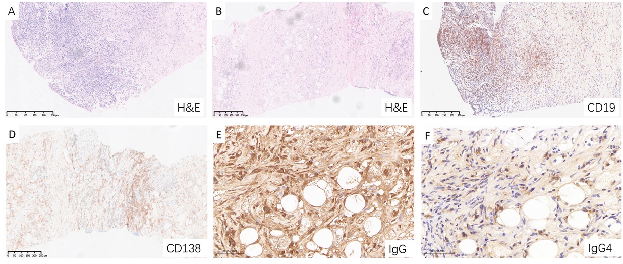 Figure 3 Characteristic pathological features of IgG4-SM in a representative patient. (A) Hematoxylin and eosin (H& E) staining showing dense lymphoplasmacytic infiltration. (B) H&E staining revealing prominent fibrosis and periadipose inflammation. (C) CD19 staining highlighting B cell infiltration. (D) CD138 staining demonstrating abundant plasma cell infiltration. (E) IgG staining showing dense infiltration of IgG-positive plasma cell. (F) IgG4 staining revealing scattered IgG4-positive plasma cell infiltration.