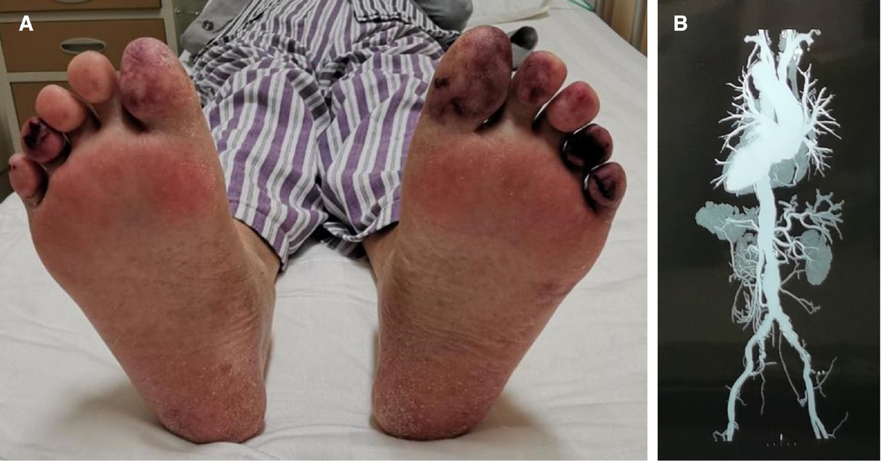 Figure 1 (A) blue toe. (B) The B shows calcified atherosclerotic plaque throughout the visualized thoracoabdominal aorta (arrow) on a three-dimensional computed tomography reconstruction.