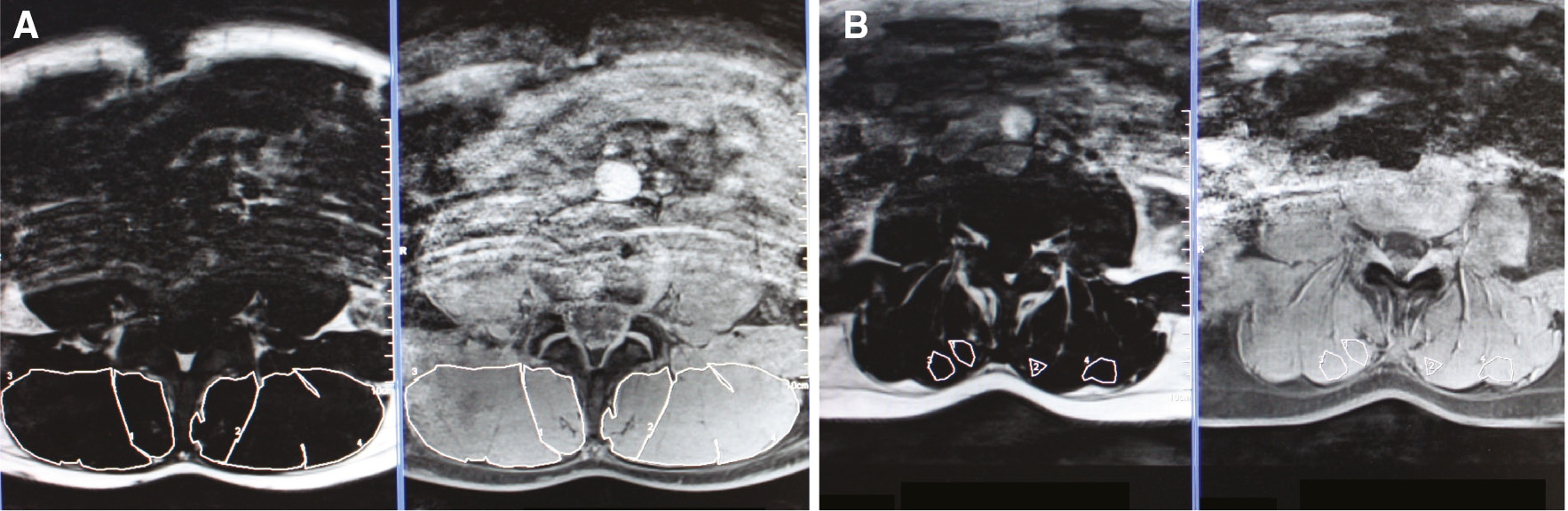 Figure 1: 
            (A) Provides the ROI of the complete left and right ES and MF. (B) Provides the ROI for MFI in the left and right ES and MF. Therefore, an area with lean muscle tissue was selected.
          