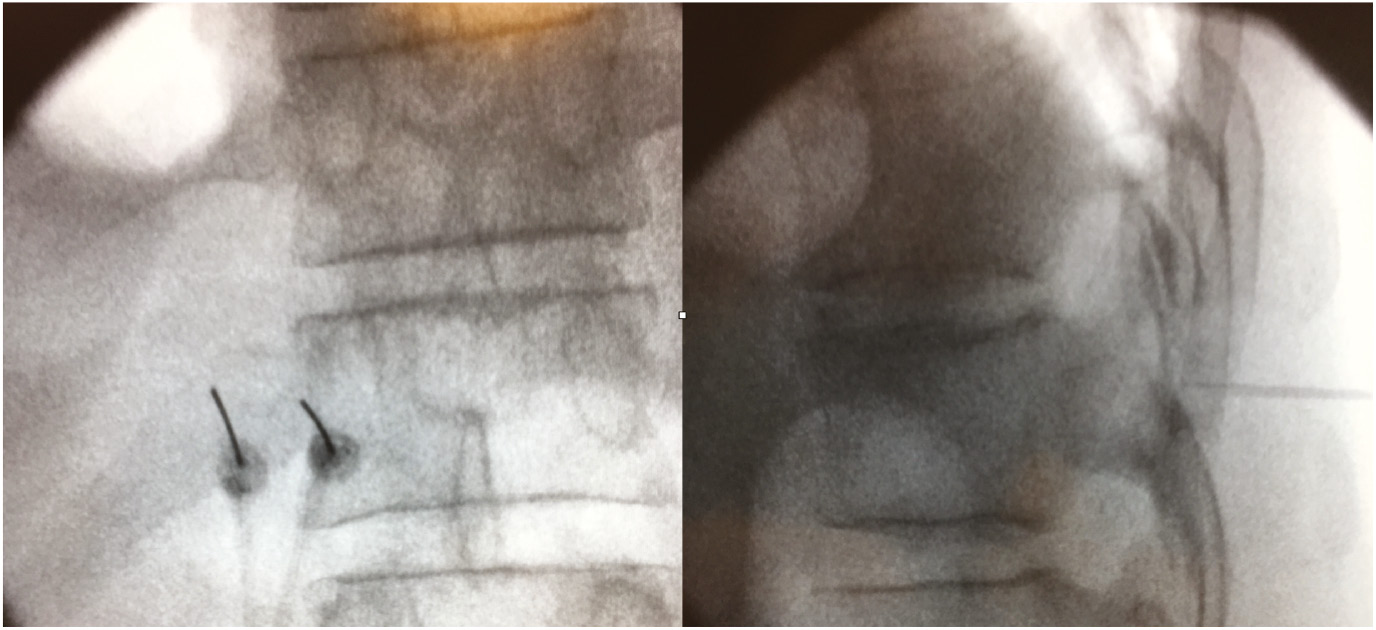 Fig. 1: 
          Anteroposterior and lateral fluoroscopic images of bipolar RF cannulas at target points (transverse process of thoracic vertebra). Note the cannulas are parallel and 10 mm apart to each other within the area of the transverse process in anteroposterior view. In lateral view, the tips of both the cannulas are located posterior to the line that connects the posterior aspects of the intervertebral foramina.
        