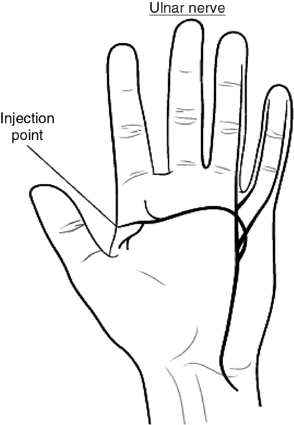 Fig. 2: 
          Anatomical location of the distal ulnar nerve branches (drawn according to reference [3]).
        