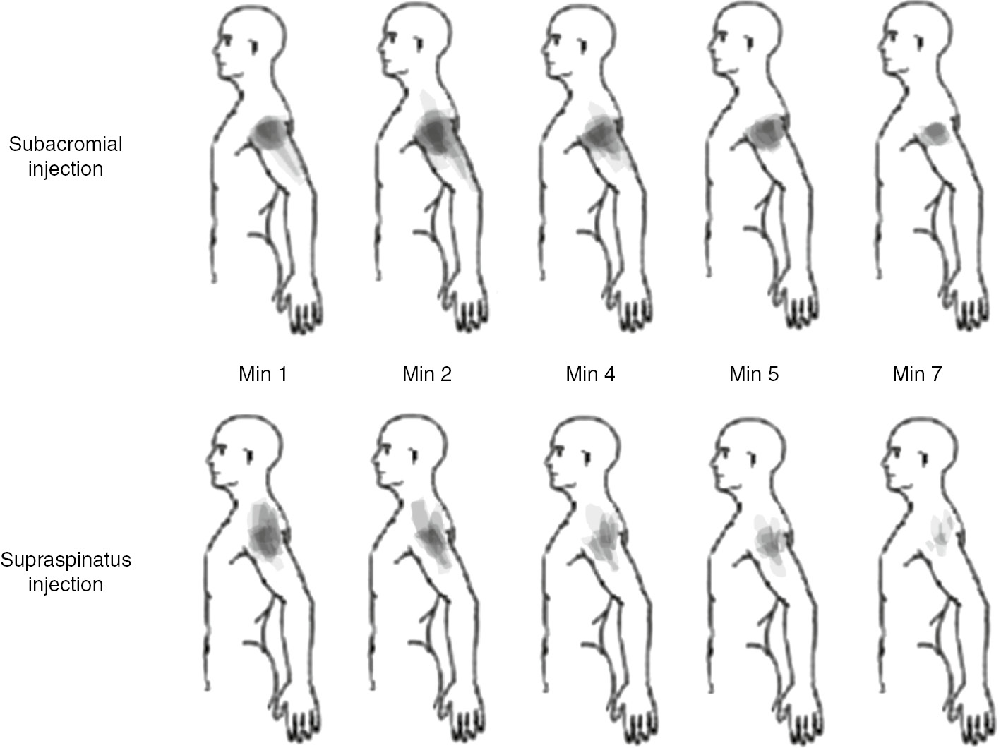 Fig. 2: 
          Composite body charts representing changes in pain distribution following injection of hypertonic saline. Coloured regions were formed by overlaying regions of pain for each participant. Darker colours indicate more participants reported pain in that area.
        