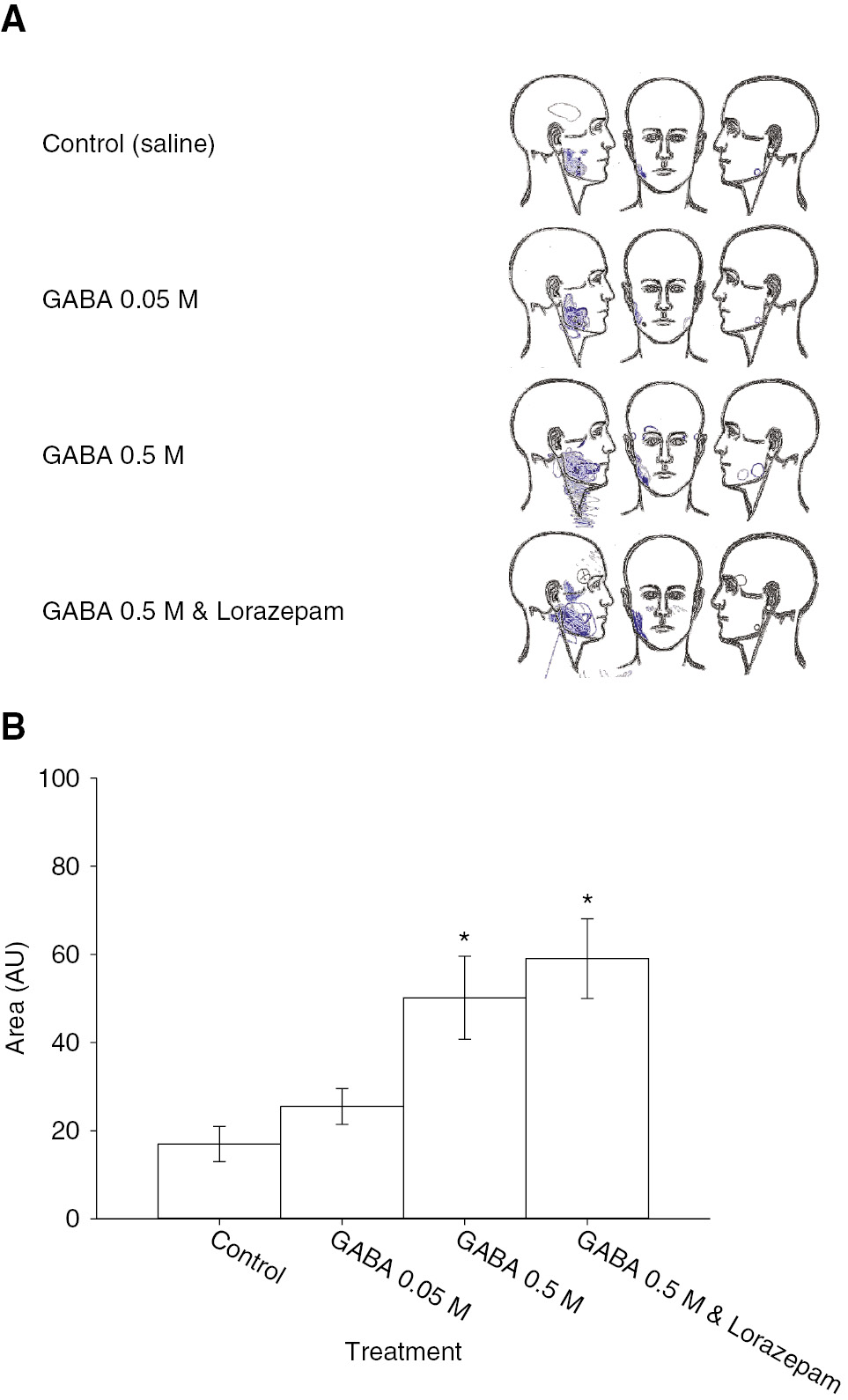 Fig. 4: 
            (A) The image shows composite pain area drawings from the 30 subjects. Pain was generally localized to the site of injection with all treatments. (B) The bar graphs show the mean pain area. There was a significant effect of treatment (F=11.489, p<0.001). The drawn pain areas for GABA 0.5 M with or without lorazepam were significantly larger than those drawn for saline. There was no significant difference between areas drawn for GABA 0.05 M and saline or between GABA 0.5 M with lorazepam and without lorazepam. Asterisks: p<0.05 compared to saline control; Error bars: SE.
          
