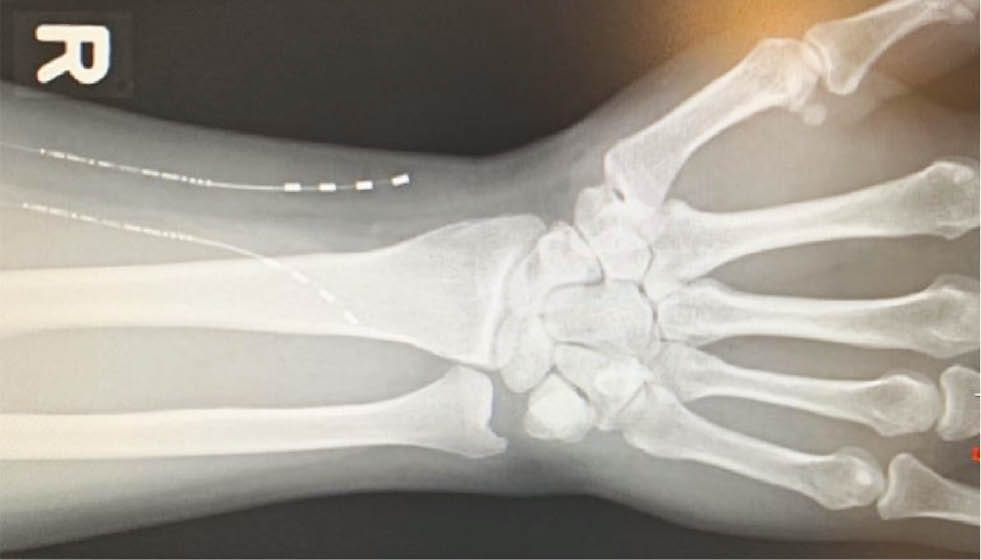 Fig. 4:
Anterior-posterior X-ray of the forearm demonstrating the location of the implanted electrodes in-situ.