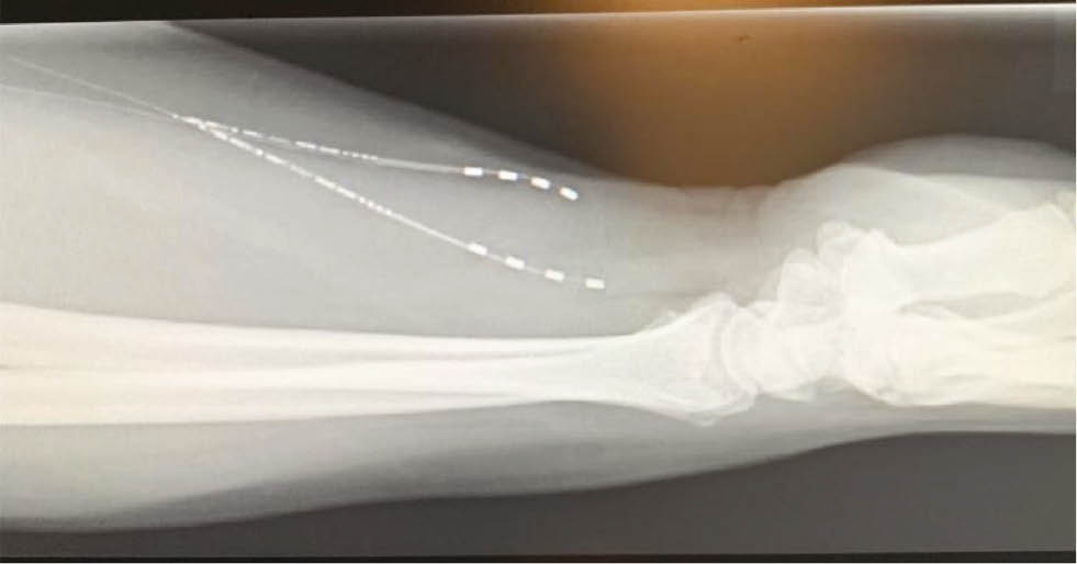 Fig. 5:
Lateral radiograph of the forearm disclosing the position of the implants at the required anatomical site.