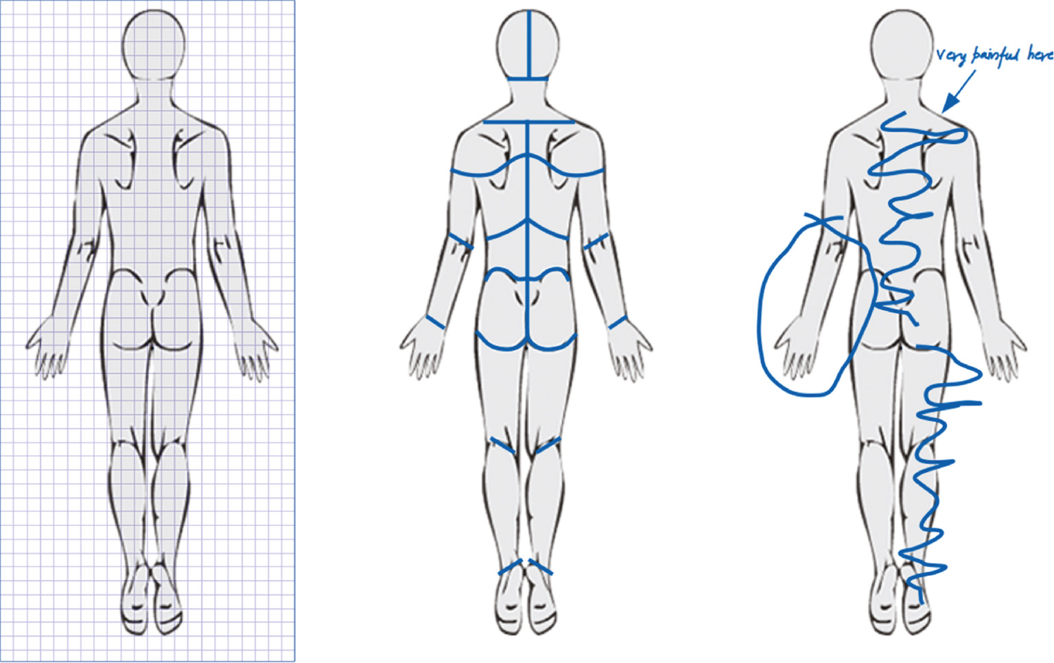 Fig. 1: 
          Stylized examples illustrating three distinct methods for quantifying pain drawings: Estimation of area (grid/pixels), counting of anatomical regions and scoring methods based on criteria such as “non-organic pain”, “whole body pain”, etc. (left-to-right).
        