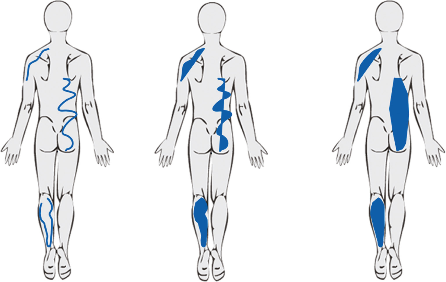 Fig. 2: 
          Constructed examples for illustrating potential problems when analyzing pain drawings. The left panel illustrates the raw pain drawing. The center panel illustrates the same drawing converted to simple, closed polygons and the right panel illustrates the convex hull polygons. Each method of area estimation has the potential for over- or underestimating the area.
        