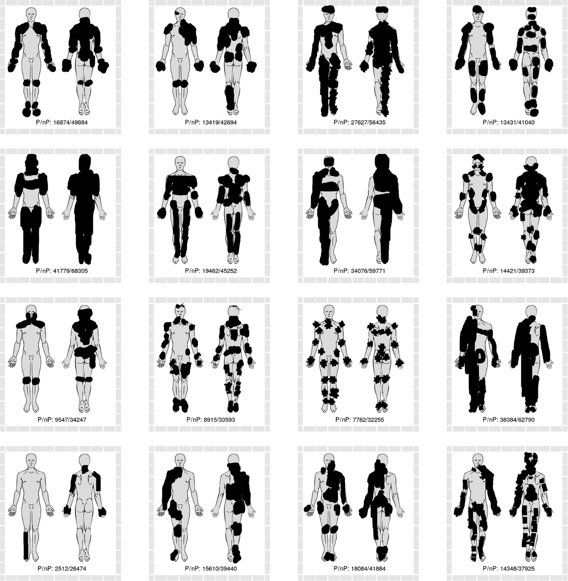 Fig. 8: 
            The sixteen pain drawings with the greatest discrepancy between polygon-based methods of area estimation (smaller area estimates) and non-polygon-based methods (greater area estimates). Numbers in drawing represent the area sum of the four polygon-based methods (P) and non-polygon-based methods (nP).
          